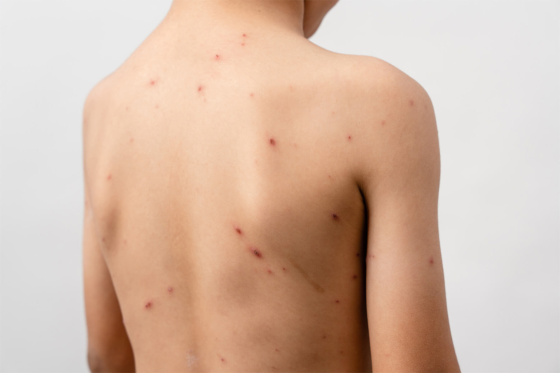 Chickenpox Recovery